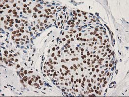 LENG1 Antibody - IHC of paraffin-embedded Adenocarcinoma of Human breast tissue using anti-LENG1 mouse monoclonal antibody.