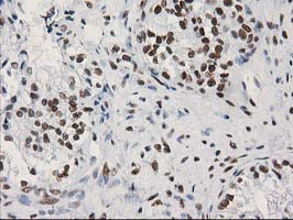 LENG1 Antibody - IHC of paraffin-embedded Adenocarcinoma of Human ovary tissue using anti-LENG1 mouse monoclonal antibody.