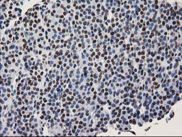 LENG1 Antibody - IHC of paraffin-embedded Carcinoma of Human thyroid tissue using anti-LENG1 mouse monoclonal antibody.