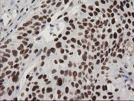 LENG1 Antibody - IHC of paraffin-embedded Carcinoma of Human bladder tissue using anti-LENG1 mouse monoclonal antibody.
