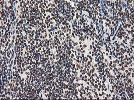 LENG1 Antibody - IHC of paraffin-embedded Human lymphoma tissue using anti-LENG1 mouse monoclonal antibody.
