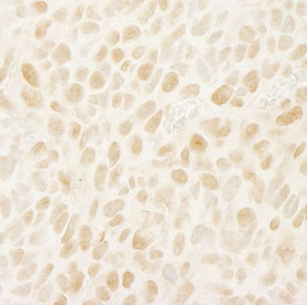 LEO1 Antibody - Detection of Mouse Leo1 by Immunohistochemistry. Sample: FFPE section of mouse colon carcinoma CT26. Antibody: Affinity purified rabbit anti-Leo1 used at a dilution of 1:100. Epitope Retrieval Buffer-High pH (IHC-101J) was substituted for Epitope Retrieval Buffer-Reduced pH.