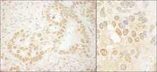 LEO1 Antibody - Detection of Human and Mouse LEO1 by Immunohistochemistry. Sample: FFPE section of human stomach carcinoma (left) and mouse teratoma (right). Antibody: Affinity purified rabbit anti-LEO1 used at a dilution of 1:5000 (0.2and 1:1000 (1 Detection: DAB.