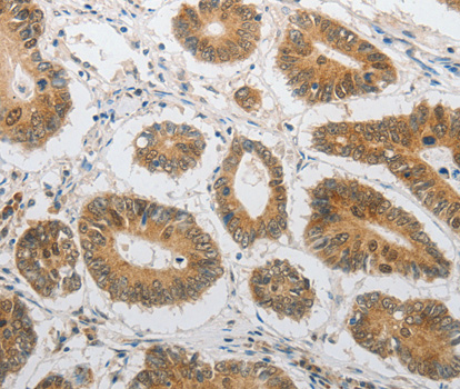 LEPR / Leptin Receptor Antibody - Immunohistochemistry of paraffin-embedded Human colon cancer tissue.