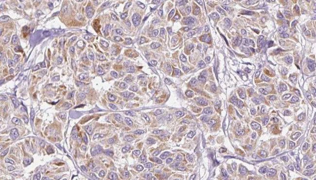 Leptin Antibody - 1:100 staining human Melanoma tissue by IHC-P. The sample was formaldehyde fixed and a heat mediated antigen retrieval step in citrate buffer was performed. The sample was then blocked and incubated with the antibody for 1.5 hours at 22°C. An HRP conjugated goat anti-rabbit antibody was used as the secondary.