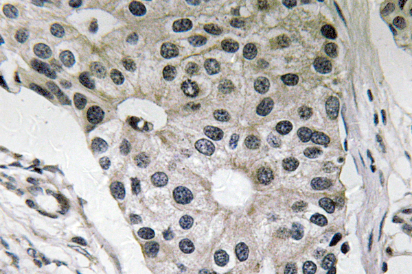 Leptin Antibody - IHC of Ob (K36) pAb in paraffin-embedded human breast carcinoma tissue.