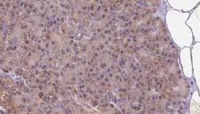 LETM1 Antibody - 1:100 staining human pancreas carcinoma tissue by IHC-P. The sample was formaldehyde fixed and a heat mediated antigen retrieval step in citrate buffer was performed. The sample was then blocked and incubated with the antibody for 1.5 hours at 22°C. An HRP conjugated goat anti-rabbit antibody was used as the secondary.