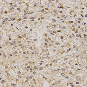 LETMD1 / HCCR1 Antibody - Immunohistochemistry of paraffin-embedded human kidney cancer using LETMD1 antibody at dilution of 1:200 (x400 lens).