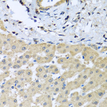 LETMD1 / HCCR1 Antibody - Immunohistochemistry of paraffin-embedded human liver injury tissue.
