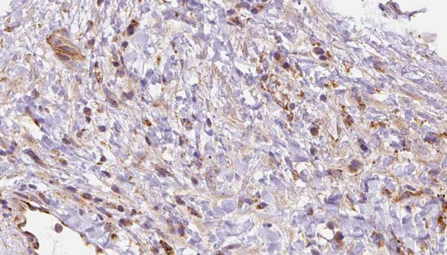 Leukotriene B4 Receptor / BLT1 Antibody - 1:100 staining human liver carcinoma tissues by IHC-P. The sample was formaldehyde fixed and a heat mediated antigen retrieval step in citrate buffer was performed. The sample was then blocked and incubated with the antibody for 1.5 hours at 22°C. An HRP conjugated goat anti-rabbit antibody was used as the secondary.