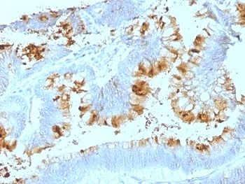 Lewis A Blood Group Antigen Antibody - Formalin-fixed, paraffin-embedded human colon carcinoma stained with Blood Group Lewis a antibody (SPM522).  This image was taken for the unmodified form of this product. Other forms have not been tested.