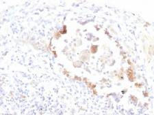 Lewis y / BG8 / CD174 Antibody - IHC testing of FFPE human lung carcinoma with Lewis y antibody (clone LWY/1463). Required HIER: boil tissue sections in 10mM citrate buffer, pH 6, for 10-20 min.