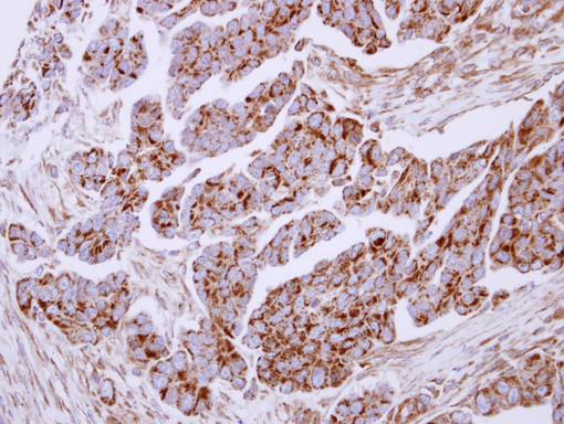 LF / LTF / Lactoferrin Antibody - IHC of paraffin-embedded Ovarian carcinoma, using Lactoferrin antibody at 1:250 dilution.