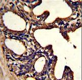 LF / LTF / Lactoferrin Antibody - Formalin-fixed and paraffin-embedded human prostate carcinoma with LTF Monoclonal Antibody, which was peroxidase-conjugated to the secondary antibody, followed by DAB staining. This data demonstrates the use of this antibody for immunohistochemistry; clinical relevance has not been evaluated.