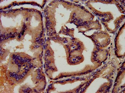 LF / LTF / Lactoferrin Antibody - IHC image of LTF Antibody diluted at 1:450 and staining in paraffin-embedded human prostate tissue performed on a Leica BondTM system. After dewaxing and hydration, antigen retrieval was mediated by high pressure in a citrate buffer (pH 6.0). Section was blocked with 10% normal goat serum 30min at RT. Then primary antibody (1% BSA) was incubated at 4°C overnight. The primary is detected by a biotinylated secondary antibody and visualized using an HRP conjugated SP system.