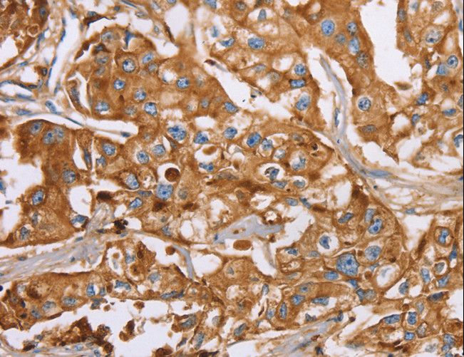 LF / LTF / Lactoferrin Antibody - Immunohistochemistry of paraffin-embedded Human breast cancer using LTF Polyclonal Antibody at dilution of 1:40.