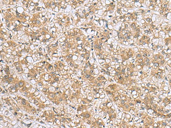 LFNG / Lunatic Fringe Antibody - Immunohistochemistry of paraffin-embedded Human liver cancer tissue  using LFNG Polyclonal Antibody at dilution of 1:60(×200)