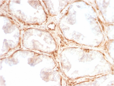LGALS1 / Galectin 1 Antibody - Formalin-fixed, paraffin-embedded Human Prostate Carcinoma stained with Galectin-1 Rabbit Recombinant Monoclonal Antibody (GAL1/2499R).