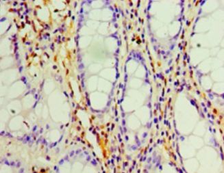LGALS1 / Galectin 1 Antibody - Immunohistochemistry of paraffin-embedded human colon cancer using antibody at 1:100 dilution.  This image was taken for the unconjugated form of this product. Other forms have not been tested.