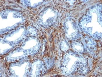 LGALS1 / Galectin 1 Antibody - IHC testing of FFPE human prostate carcinoma with Galectin 1 antibody (clone GAL1/1831). Required HIER: boil tissue sections in 10mM citrate buffer, pH 6, for 10-20 min.