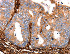 LGALS1 / Galectin 1 Antibody - Immunohistochemistry of paraffin-embedded Human cervical cancer using LGALS1 Polyclonal Antibody at dilution of 1:25.