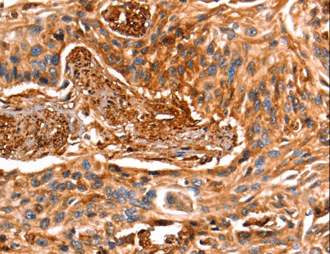 LGALS1 / Galectin 1 Antibody - Immunohistochemistry of paraffin-embedded Human esophagus cancer using LGALS1 Polyclonal Antibody at dilution of 1:25.