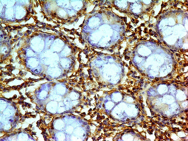 LGALS1 / Galectin 1 Antibody - Fig-4: Immunohistochemical analysis of Galectin-1. Anti-Galectin-1 was used in Colon Carcinoma tissue at 2 µg/ml.