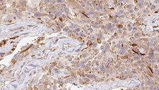 LGALS1 / Galectin 1 Antibody - 1:100 staining human Melanoma tissue by IHC-P. The sample was formaldehyde fixed and a heat mediated antigen retrieval step in citrate buffer was performed. The sample was then blocked and incubated with the antibody for 1.5 hours at 22°C. An HRP conjugated goat anti-rabbit antibody was used as the secondary.