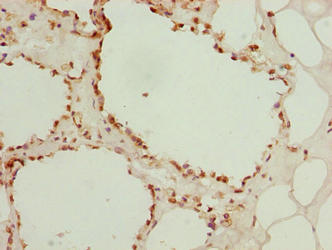 LGALS12 / Galectin 12 Antibody - Immunohistochemistry of paraffin-embedded human breast cancer using LGALS12 Antibody at dilution of 1:100