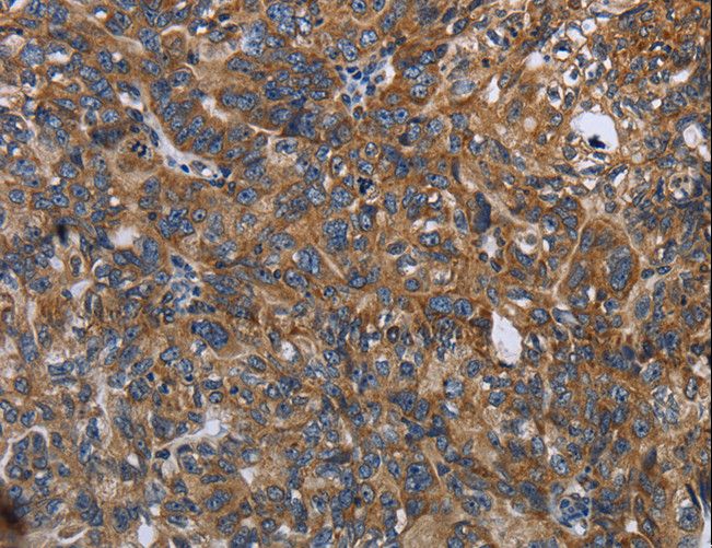 LGALS2 / Galectin 2 Antibody - Immunohistochemistry of paraffin-embedded Human ovarian cancer using LGALS2 Polyclonal Antibody at dilution of 1:30.