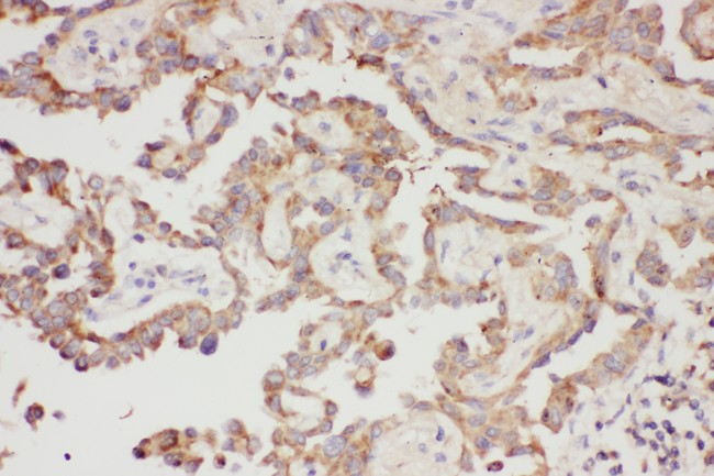 LGALS3 / Galectin 3 Antibody - Galectin 3 antibody IHC-paraffin: Human Lung Cancer Tissue.