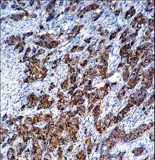 LGALS3 / Galectin 3 Antibody - LGALS3 Antibody immunohistochemistry of formalin-fixed and paraffin-embedded human breast carcinoma followed by peroxidase-conjugated secondary antibody and DAB staining.