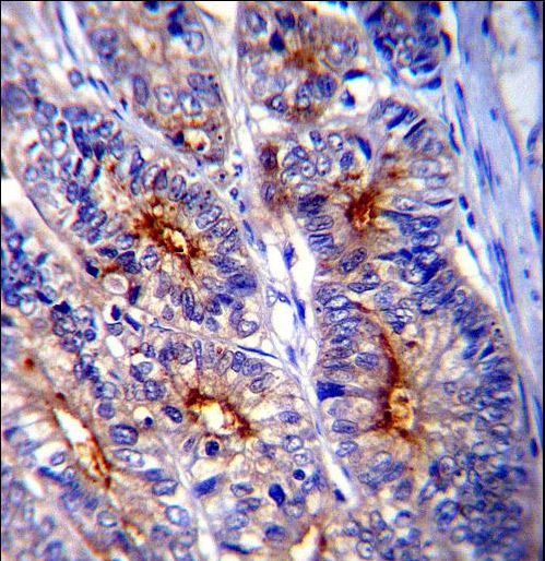 LGALS3 / Galectin 3 Antibody - LGALS3 Antibody immunohistochemistry of formalin-fixed and paraffin-embedded human colon carcinoma followed by peroxidase-conjugated secondary antibody and DAB staining.
