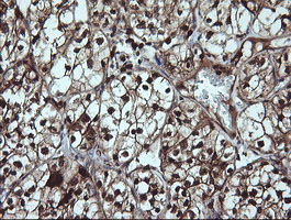LGALS3 / Galectin 3 Antibody - IHC of paraffin-embedded Carcinoma of Human kidney tissue using anti-LGALS3 mouse monoclonal antibody.
