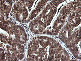 LGALS3 / Galectin 3 Antibody - IHC of paraffin-embedded Carcinoma of Human pancreas tissue using anti-LGALS3 mouse monoclonal antibody.