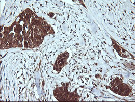 LGALS3 / Galectin 3 Antibody - IHC of paraffin-embedded Carcinoma of Human bladder tissue using anti-LGALS3 mouse monoclonal antibody. (Heat-induced epitope retrieval by 10mM citric buffer, pH6.0, 120°C for 3min).