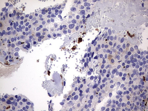 LGALS3 / Galectin 3 Antibody - IHC of paraffin-embedded Adenocarcinoma of Human breast tissue using anti-LGALS3 mouse monoclonal antibody. (Heat-induced epitope retrieval by 1 mM EDTA in 10mM Tris, pH8.5, 120°C for 3min).