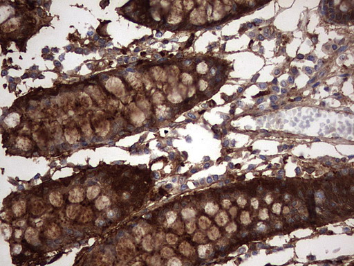 LGALS3 / Galectin 3 Antibody - IHC of paraffin-embedded Human colon tissue using anti-LGALS3 mouse monoclonal antibody. (Heat-induced epitope retrieval by 1 mM EDTA in 10mM Tris, pH8.5, 120°C for 3min).