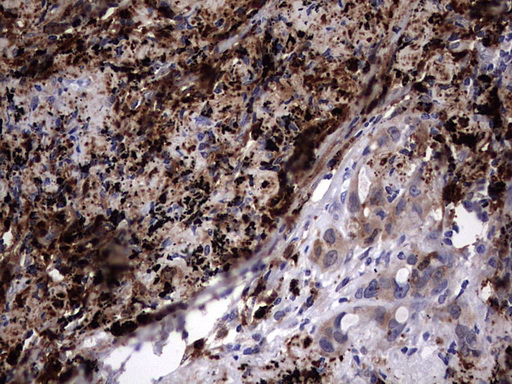 LGALS3 / Galectin 3 Antibody - IHC of paraffin-embedded Carcinoma of Human lung tissue using anti-LGALS3 mouse monoclonal antibody. (Heat-induced epitope retrieval by 1 mM EDTA in 10mM Tris, pH8.5, 120°C for 3min).