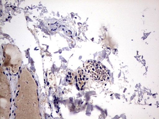 LGALS3 / Galectin 3 Antibody - IHC of paraffin-embedded Human thyroid tissue using anti-LGALS3 mouse monoclonal antibody. (Heat-induced epitope retrieval by 1 mM EDTA in 10mM Tris, pH8.5, 120°C for 3min).