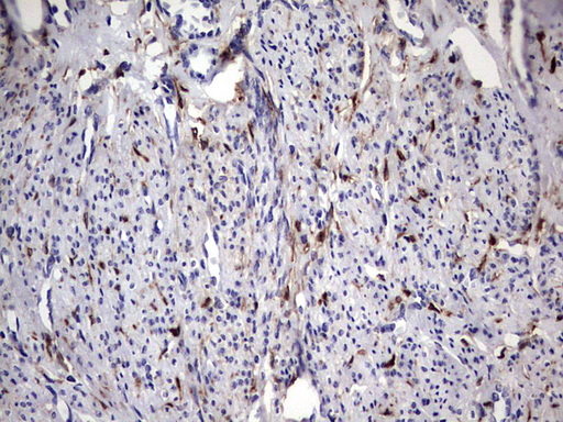 LGALS3 / Galectin 3 Antibody - IHC of paraffin-embedded Adenocarcinoma of Human endometrium tissue using anti-LGALS3 mouse monoclonal antibody. (Heat-induced epitope retrieval by 1 mM EDTA in 10mM Tris, pH8.5, 120°C for 3min).