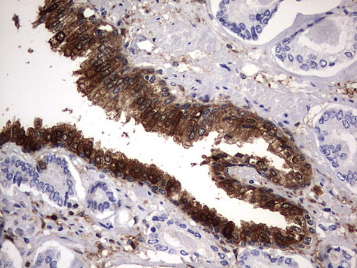 LGALS3 / Galectin 3 Antibody - IHC of paraffin-embedded Human prostate tissue using anti-LGALS3 mouse monoclonal antibody. (Heat-induced epitope retrieval by 1 mM EDTA in 10mM Tris, pH8.5, 120°C for 3min).