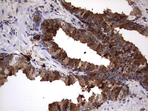 LGALS3 / Galectin 3 Antibody - IHC of paraffin-embedded Carcinoma of Human prostate tissue using anti-LGALS3 mouse monoclonal antibody. (Heat-induced epitope retrieval by 1 mM EDTA in 10mM Tris, pH8.5, 120°C for 3min).
