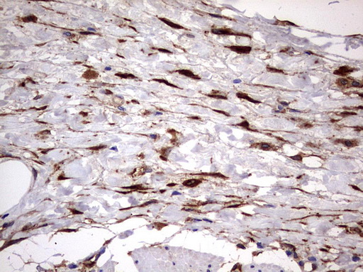LGALS3 / Galectin 3 Antibody - IHC of paraffin-embedded Human bladder tissue using anti-LGALS3 mouse monoclonal antibody. (Heat-induced epitope retrieval by 1 mM EDTA in 10mM Tris, pH8.5, 120°C for 3min).