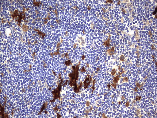 LGALS3 / Galectin 3 Antibody - IHC of paraffin-embedded Human lymphoma tissue using anti-LGALS3 mouse monoclonal antibody. (Heat-induced epitope retrieval by 1 mM EDTA in 10mM Tris, pH8.5, 120°C for 3min).