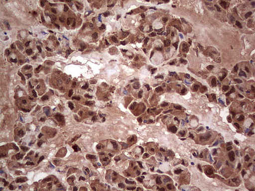 LGALS3 / Galectin 3 Antibody - Immunohistochemical staining of paraffin-embedded Carcinoma of Human lung tissue using anti-LGALS3 mouse monoclonal antibody. (Heat-induced epitope retrieval by 1 mM EDTA in 10mM Tris, pH8.5, 120C for 3min,