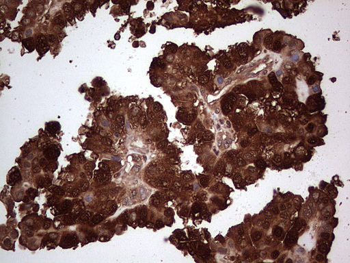 LGALS3 / Galectin 3 Antibody - Immunohistochemical staining of paraffin-embedded Adenocarcinoma of Human ovary tissue using anti-LGALS3 mouse monoclonal antibody. (Heat-induced epitope retrieval by 1 mM EDTA in 10mM Tris, pH8.5, 120C for 3min,