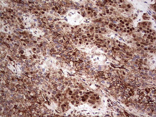 LGALS3 / Galectin 3 Antibody - Immunohistochemical staining of paraffin-embedded Carcinoma of Human thyroid tissue using anti-LGALS3 mouse monoclonal antibody. (Heat-induced epitope retrieval by 1 mM EDTA in 10mM Tris, pH8.5, 120C for 3min,