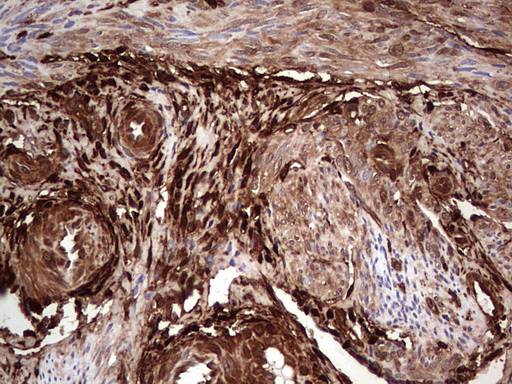 LGALS3 / Galectin 3 Antibody - Immunohistochemical staining of paraffin-embedded Human endometrium tissue within the normal limits using anti-LGALS3 mouse monoclonal antibody. (Heat-induced epitope retrieval by 1 mM EDTA in 10mM Tris, pH8.5, 120C for 3min,