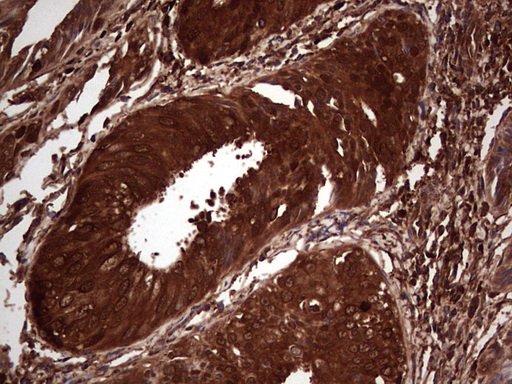 LGALS3 / Galectin 3 Antibody - Immunohistochemical staining of paraffin-embedded Adenocarcinoma of Human endometrium tissue using anti-LGALS3 mouse monoclonal antibody. (Heat-induced epitope retrieval by 1 mM EDTA in 10mM Tris, pH8.5, 120C for 3min,